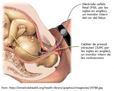 Imnatge d'un Registre cardiotocogràfic intern