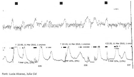 Imatge d'un Gràfic registre cardiotocogràfic