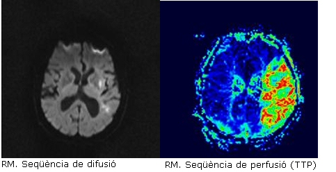 Imatge d'exemple.Trombectomia mecànica de rescat en el ictus isquèmic. 