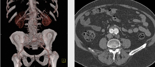 Imatge Tractament endoluminal d'aneurismes aòrtics URVI (UDIAT)