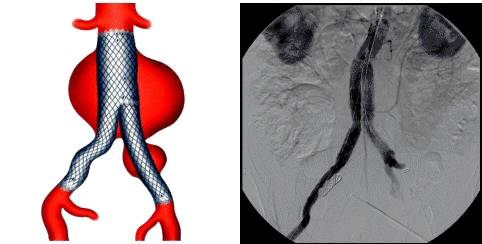 Imatge. Tractament endoluminal d'aneurismes aòrtics. URVI (UDIAT)