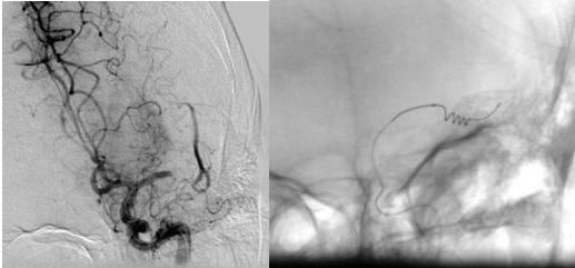 Exemple. Trombectomia mecànica de rescat en el ictus isquèmic