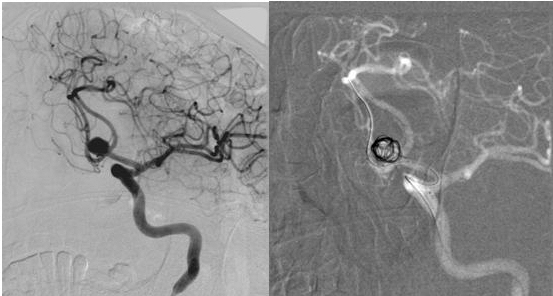 Imatge exemple. Embolització d’aneurisma cerebral amb tècnica de remodeling amb baló