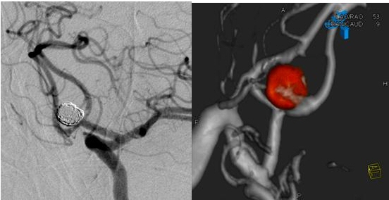 Imatge exemple. Embolització d’aneurisma cerebral amb tècnica de remodeling amb baló