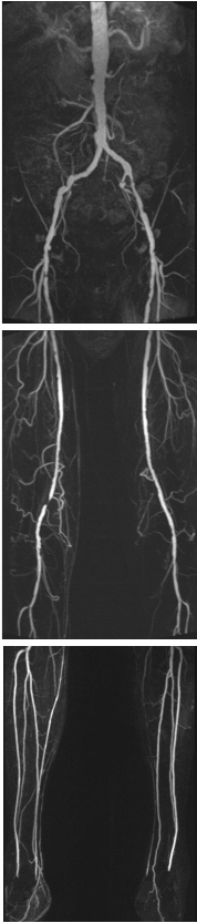 Imatge RM vascular membres inferiors. URVI  (UDIAT)